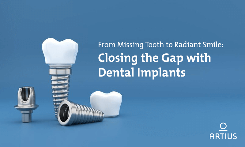 From Missing Tooth to Radiant Smile: Closing the Gap with Dental Implants